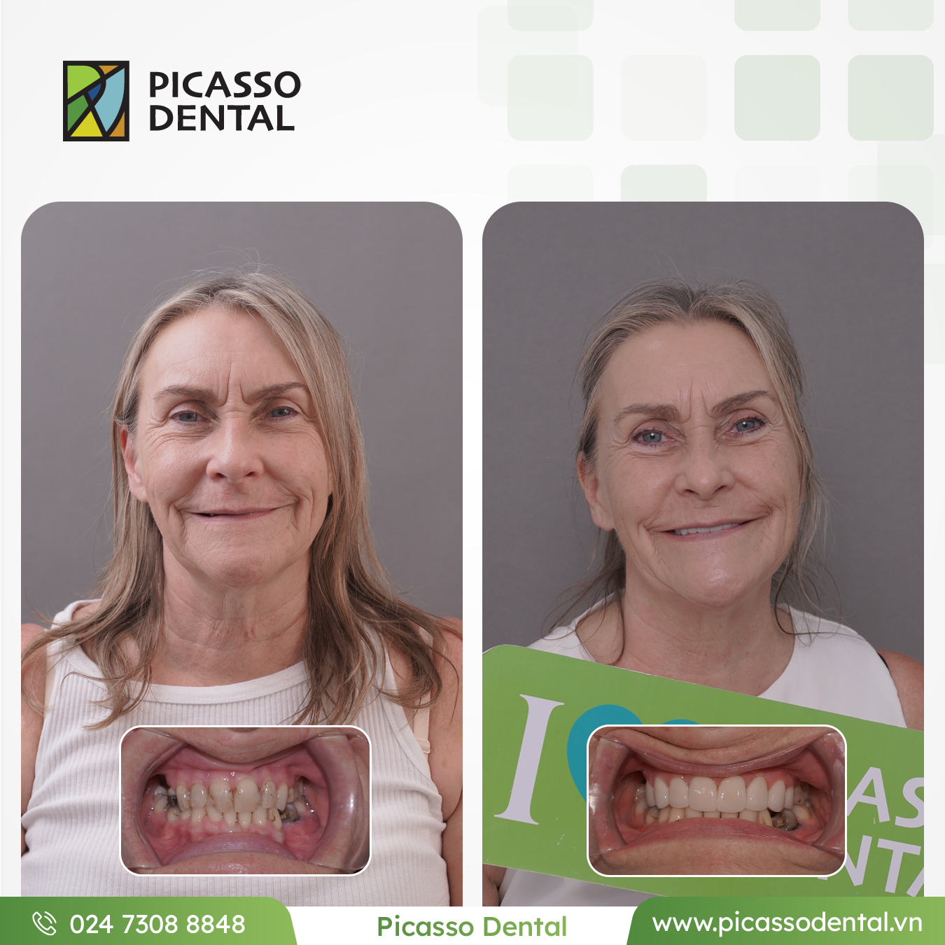ဆင်သွား (Dentures) ကုသမှုရလဒ် — ပီကာဆို ဒင်တယ်